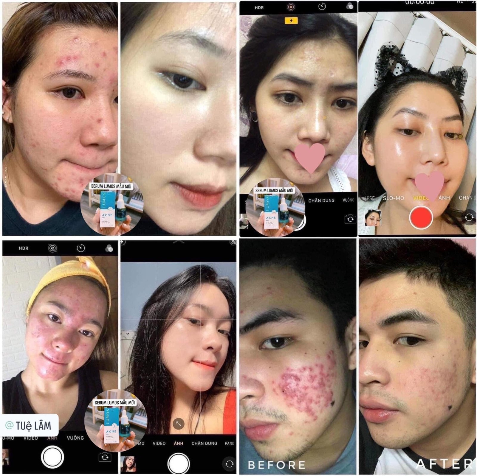 Serum Lumos Acne Chuyên Cho Da Mụn