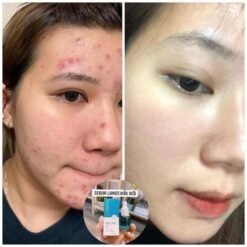 Serum Lumos Acne Chuyên Cho Da Mụn