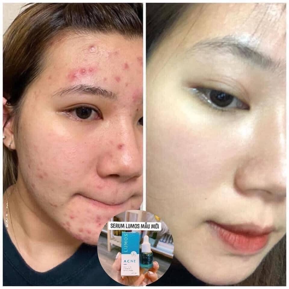 Serum Lumos Acne Chuyên Cho Da Mụn