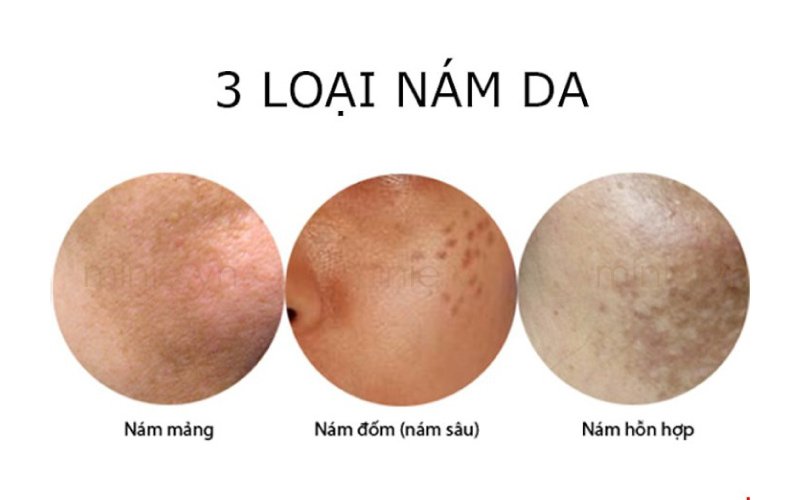 nam-da-mat-la-gi nam-da-mat-la-gi