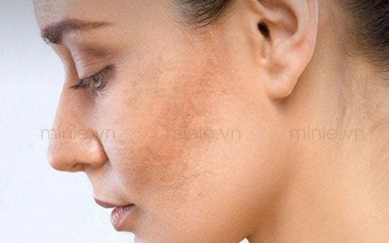 vi-sao-da-sam-den-khong-deu-mau