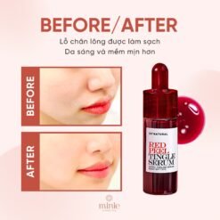 Serum So'Natural Tái Tạo Peel Da Sinh Học 11ml Red Peel Tingle Serum