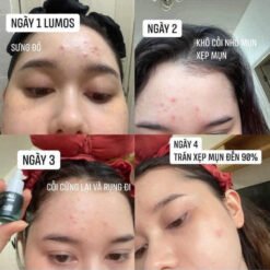 Serum Lumos Acne Chuyên Cho Da Mụn