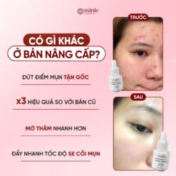 Serum Lumos Acne Chuyên Cho Da Mụn