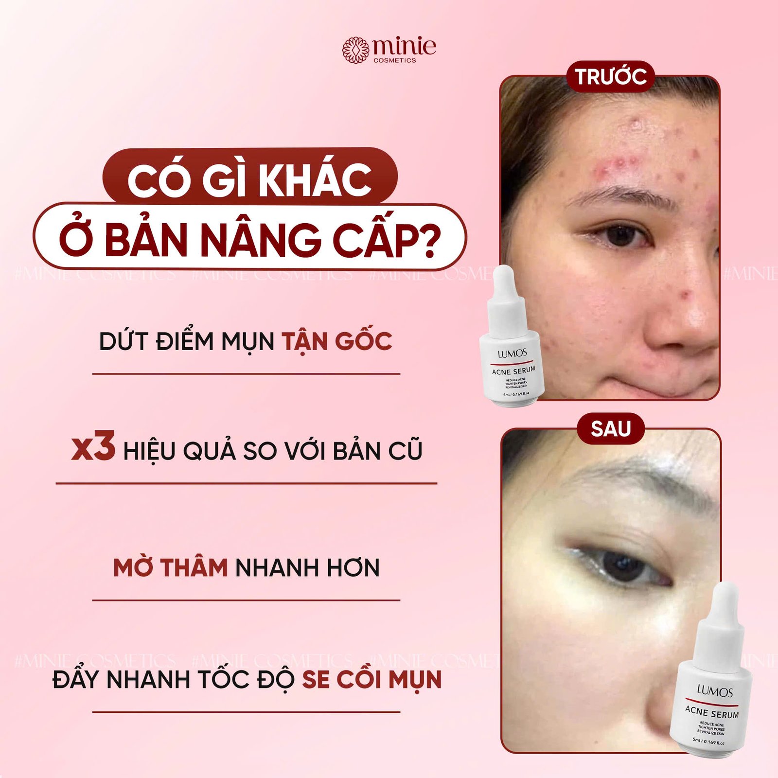 Serum Lumos Acne Chuyên Cho Da Mụn